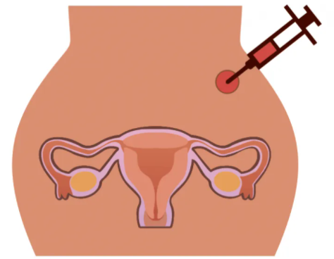 国内三代试管代孕生殖机构,人授好还是直接试管好?
