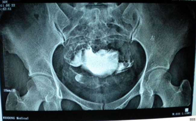 国内供卵代生宝宝,二胎试管*经历！经历过试管的女人都是伟大的！