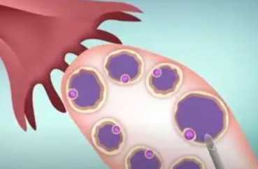 中国哪里可以做供卵手术,肝素保胎打到孕12周还怕胎停吗？